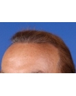 After Hair Transplant&nbsp;2 Sessions (Areas)